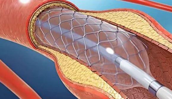 অক্টোবর থেকে হার্টের রিংয়ের নতুন দাম কার্যকর